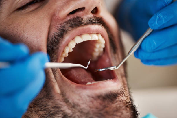 Best Emergency Dental Care for Broken or Chipped Teeth in Wilkesboro, NC