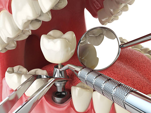 Best Emergency Denture Repair in Wilkesboro, NC